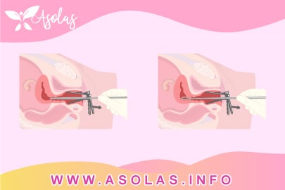- Asolas.info Como expulsar restos después de un aborto